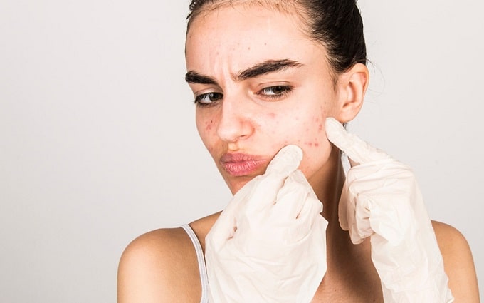 Mujer lidiando con acnes